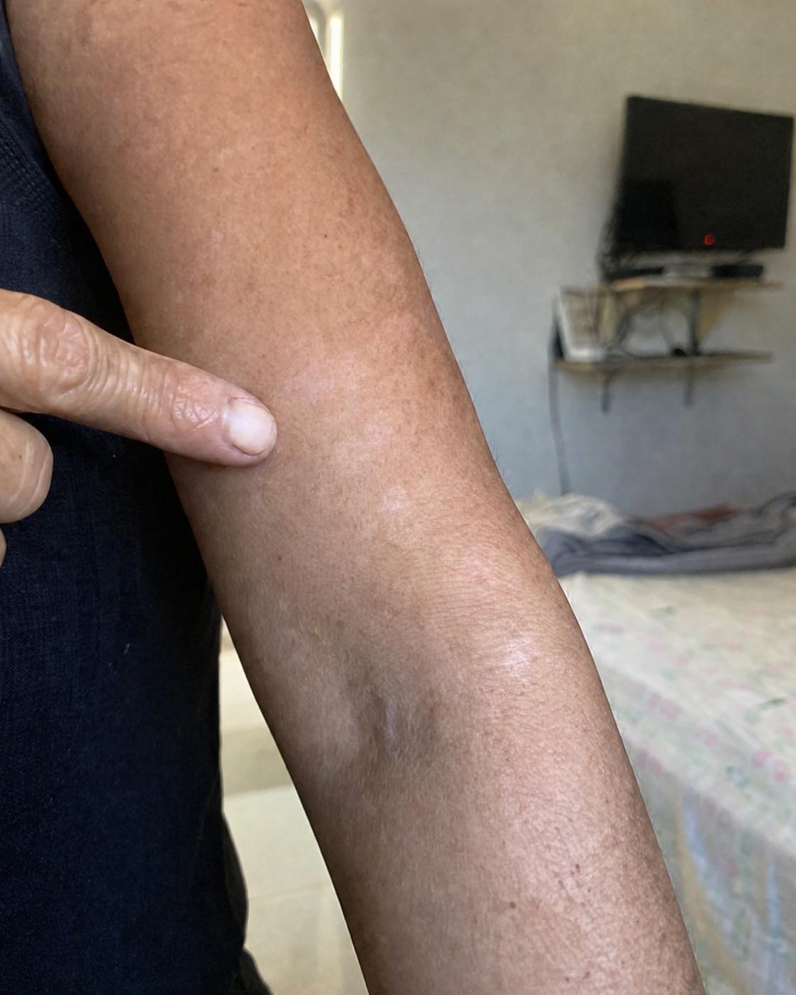 Weiße Flecken auf der Haut: Was steckt dahinter und welche Ursachen gibt es?