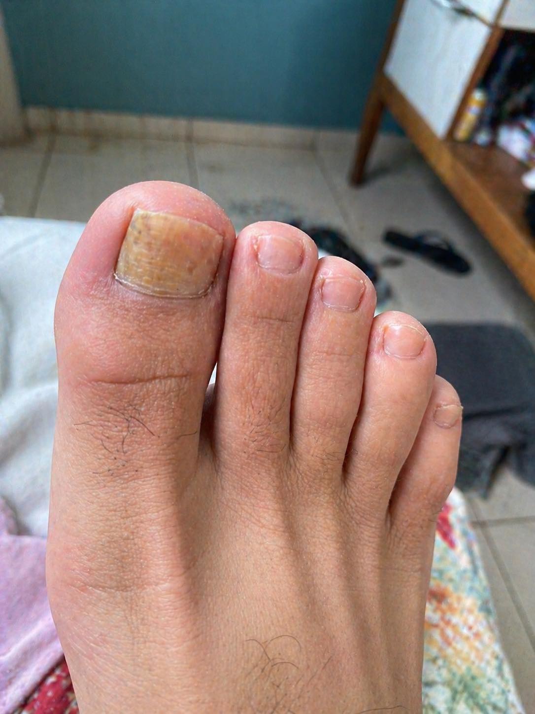 Verabschieden Sie sich von Nagelpilz mit diesem einfachen Naturheilmittel