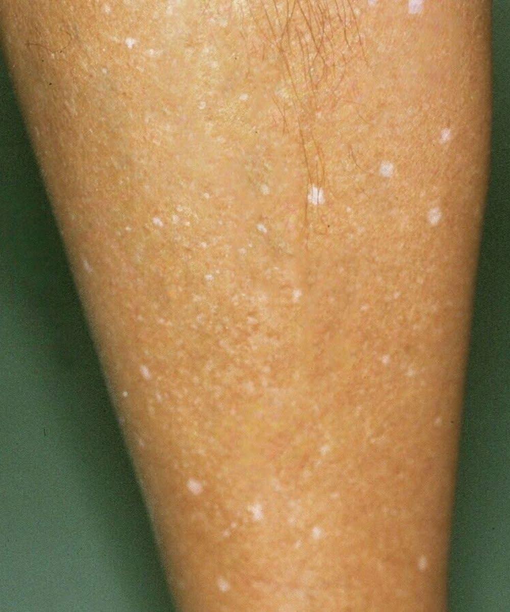 Was steckt hinter weißen Flecken auf der Haut? Mögliche Ursachen im Überblick